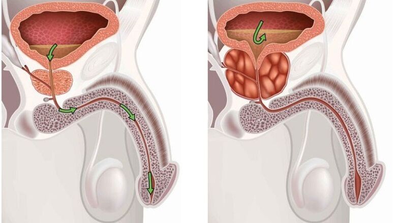 Healthy and inflamed prostate gland with prostatitis
